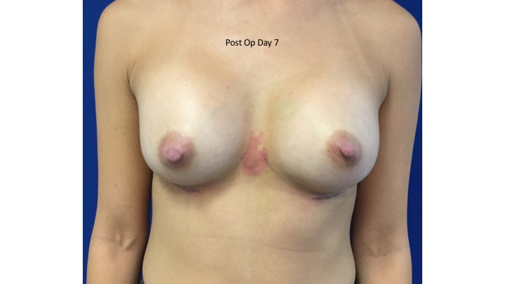Unusual Complication after Breast Augmentation content media