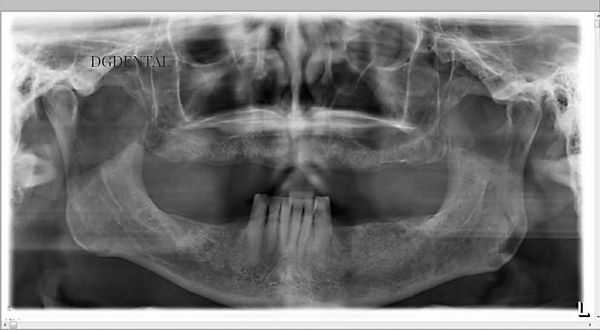 x-ray of a patient without teeth