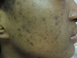 Messieurs la solution pour vos imperfections