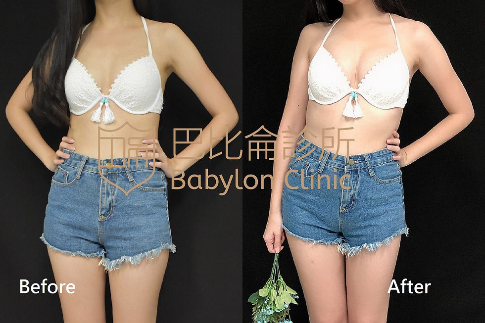 自體脂肪隆乳