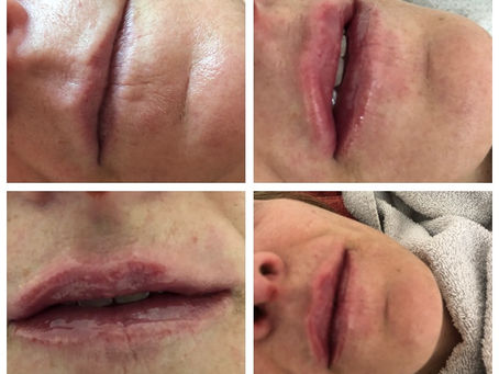 Lippen Vergrößerung und konturieren