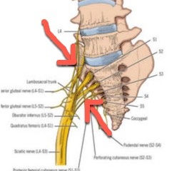 What is Sciatica?