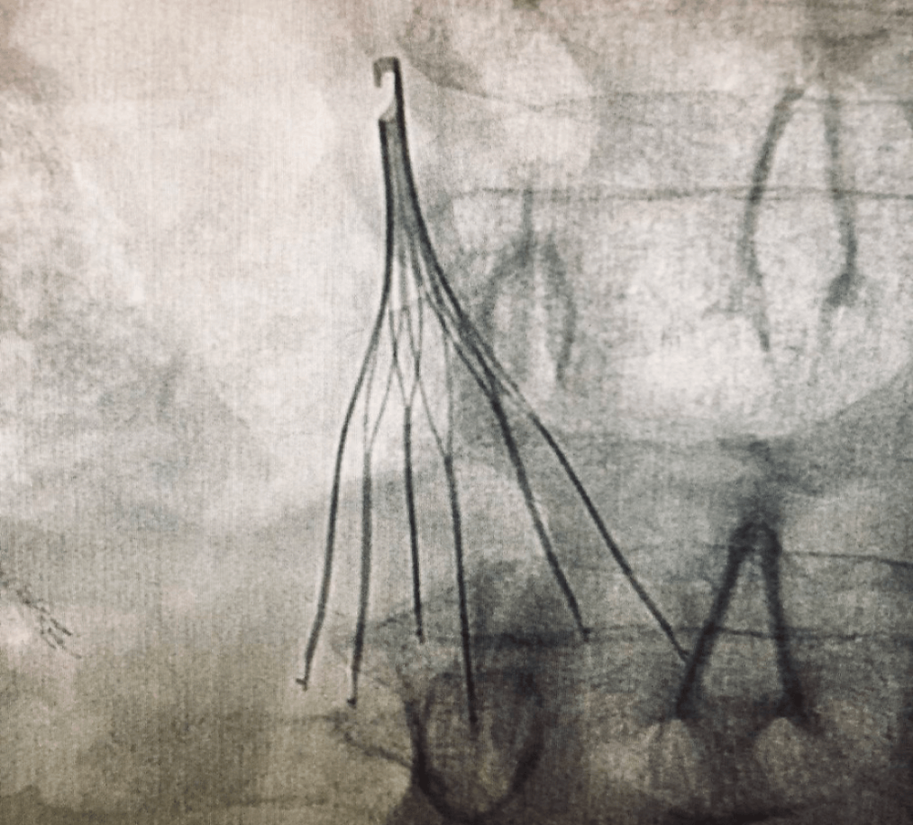 IVC-filter-OTW-technique-over-the-wire