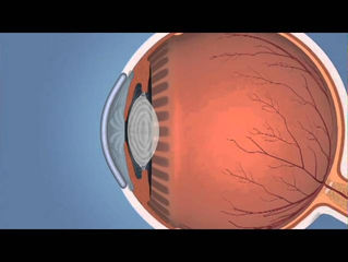 ¿Que es el Glaucoma?