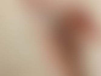 National Burn Survivor’s Week, My story part 2