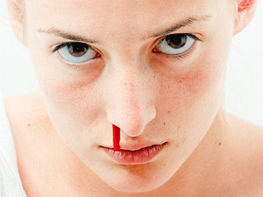 Nosebleed in Children