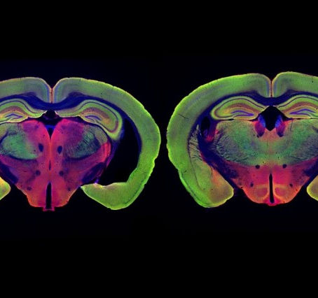 Possible Positive Outcome of Visual Stimulation to Alzheimer’s