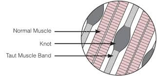 Treatment for muscle knots.