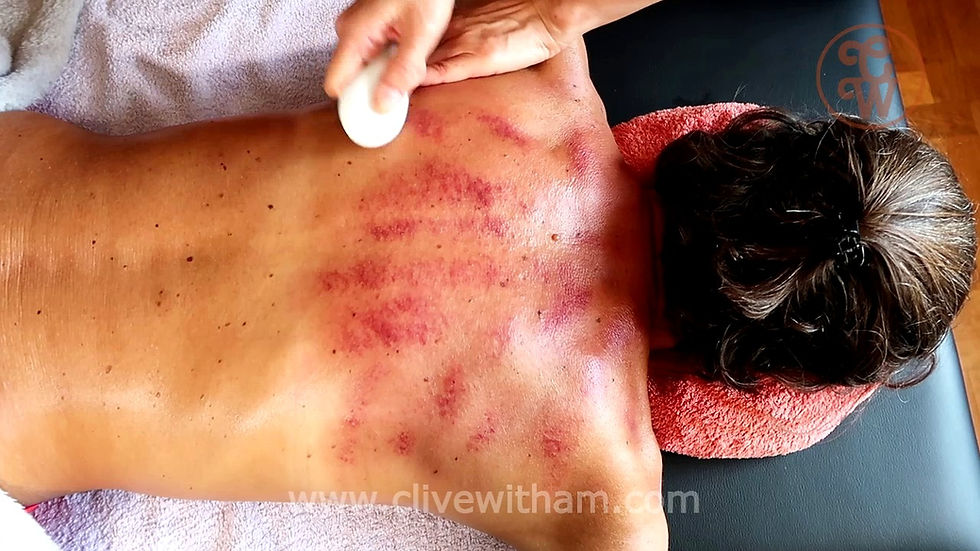 Gua Sha red dots appearing on skin - Dark sha indicating a deeper problem