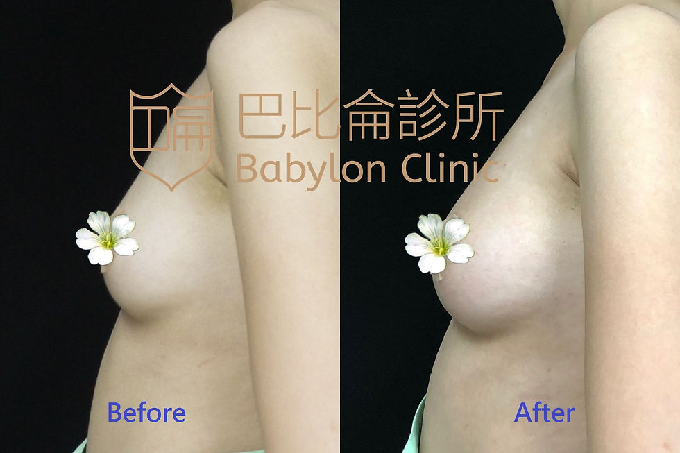 自體脂肪隆乳before after