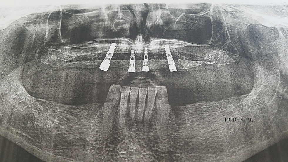 colocacion de 4 implantes para colocar una protesis completa
