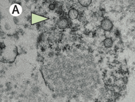 COVID-19 risk factors: high blood pressure or high blood pressure medications?