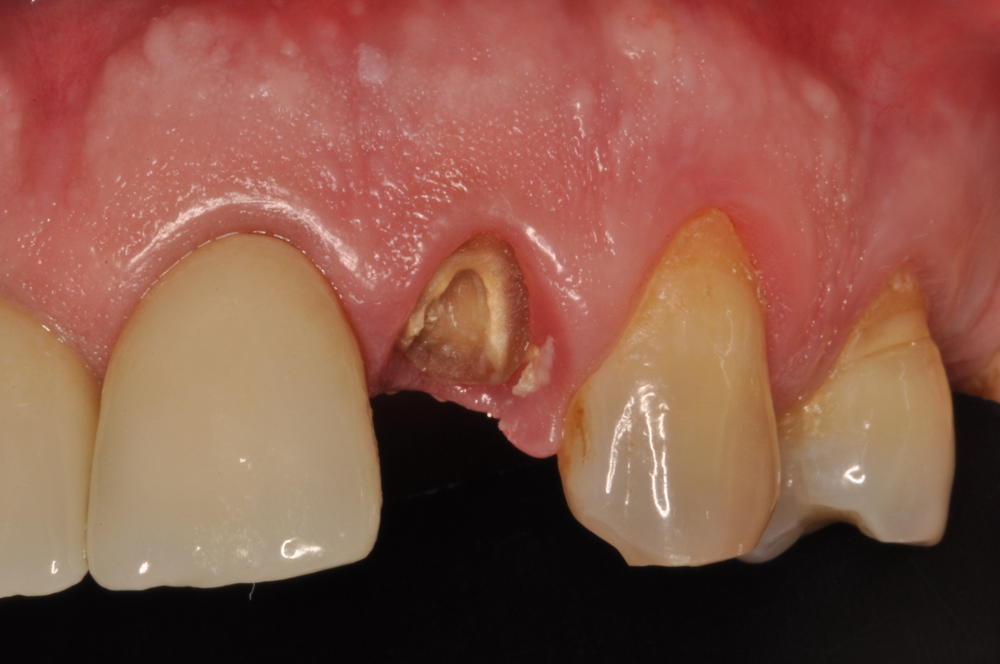 POST EXTRACTIVE IMPLANT FOUR YEARS FOLLW UP content media