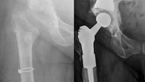 Patients: LIFE AFTER A HIP INFECTION