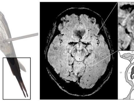 A Cauda da Andorinha: RM e o diagnóstico de Parkinson