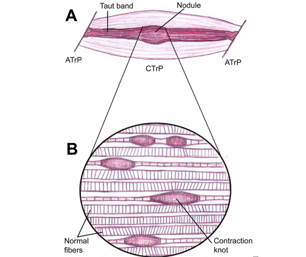 What is Trigger Point Therapy?
