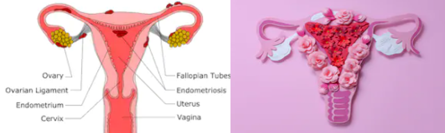 endometriosis; PCOS