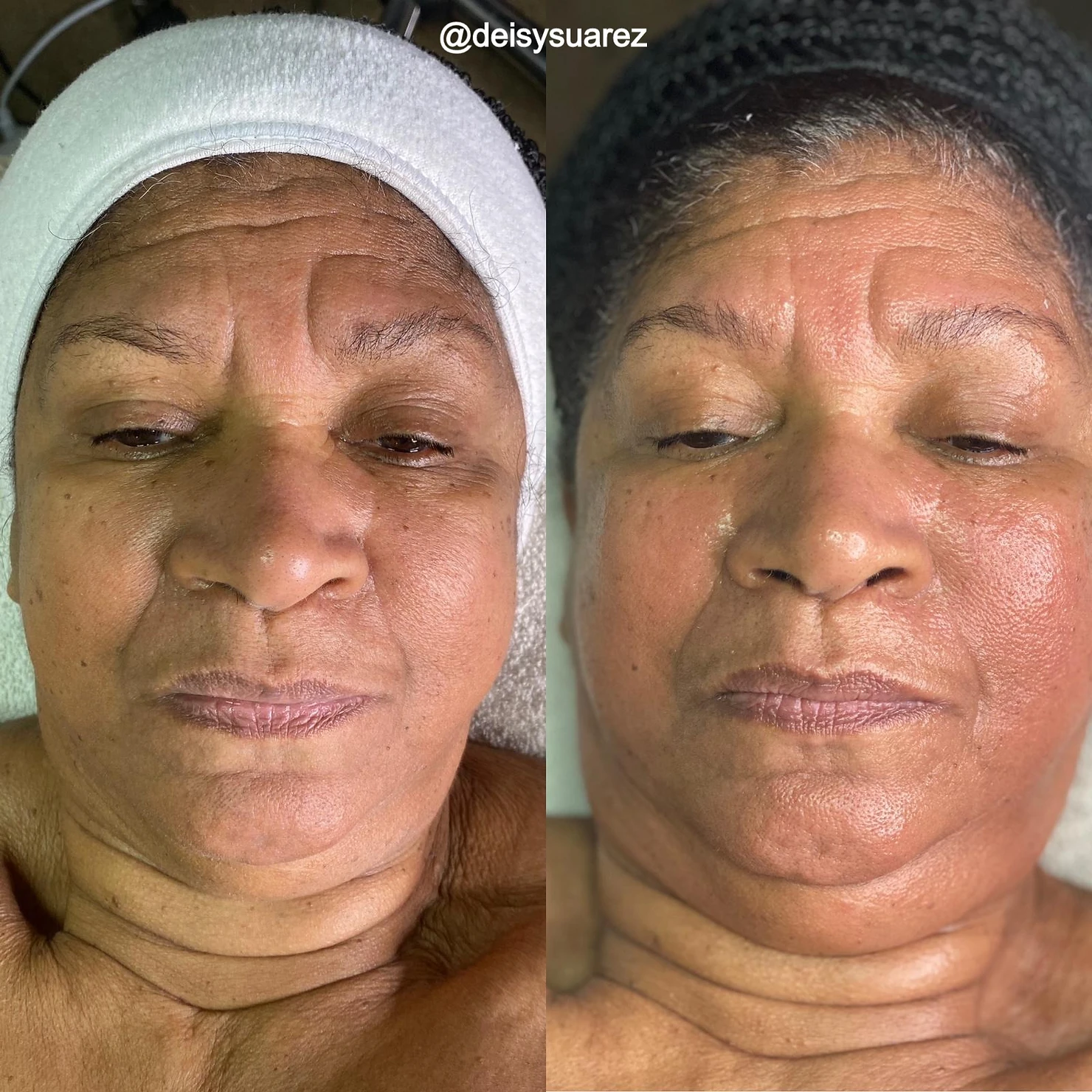 Before & after 1 micro-current treatment by @deisysuarez. Lines are visibly reduced and softened.