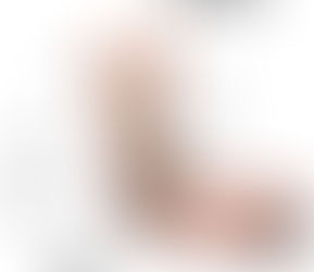 Esguince lateral de tobillo: ¿Qué necesitamos saber?