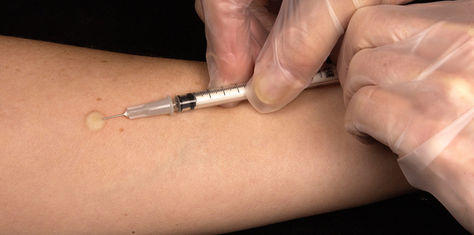 TB Skin Test
