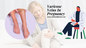 Painful Veins In Pregnancy