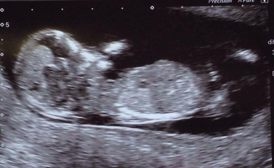 Miscarriage - A Dads' Perspective content media