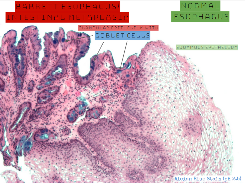 High Yield GI Pathology Esophagus GERD & Barrett Metaplasia