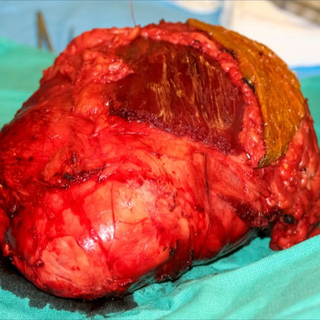 O que é o Sarcoma de Partes Moles?