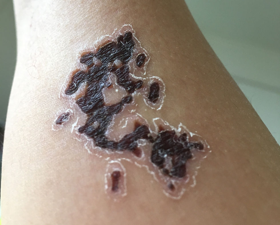 The rash looks like a map of an island, complete with a coastline demarcation around the edges