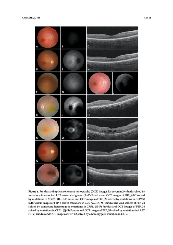 Molecular Screening of 43 Brazilian Families Diagnosed with Leber