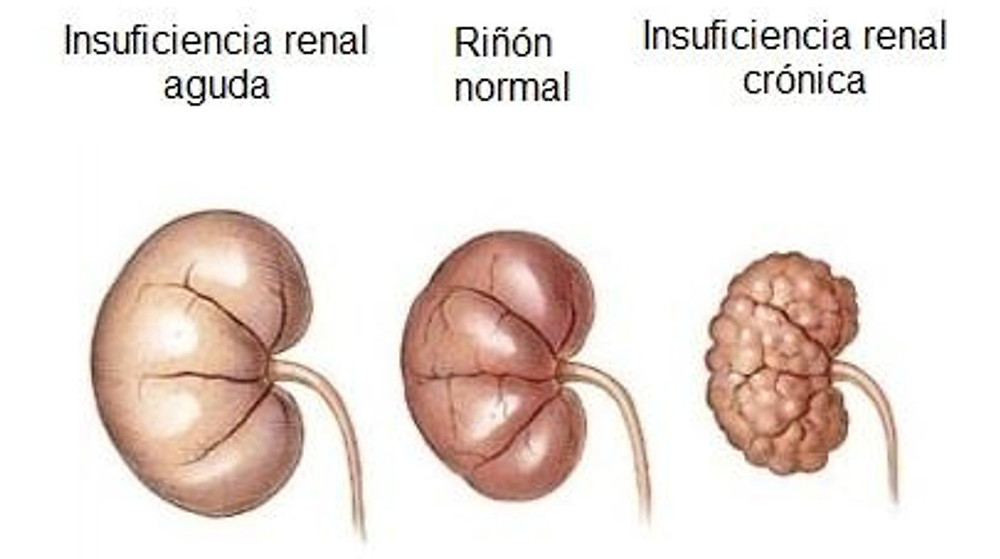 LESION RENAL AGUDA lesion-renal-aguda