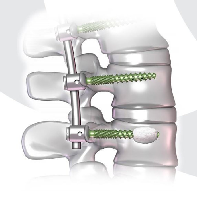 Depuy Synthes VIPER® Cortical Fix Fenestrated Screw System. Catalog