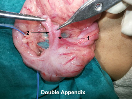 Double Appendix