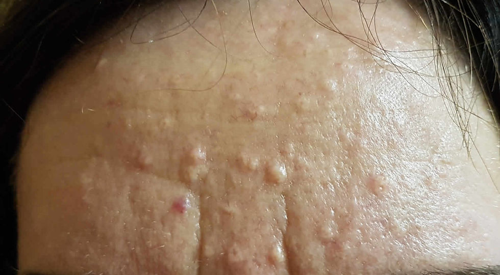 What Are These Small Bumps On My Face Sebaceous Hyperplasia By Joanna Koussertari