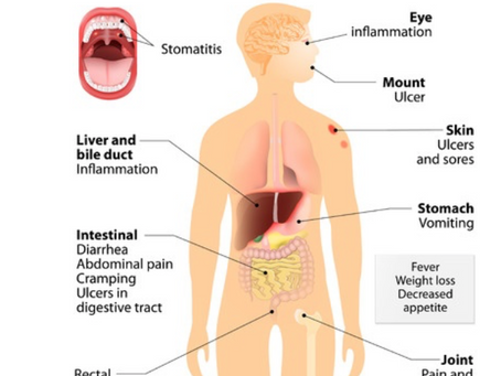 Cannabis Treatment for Crohn’s Disease