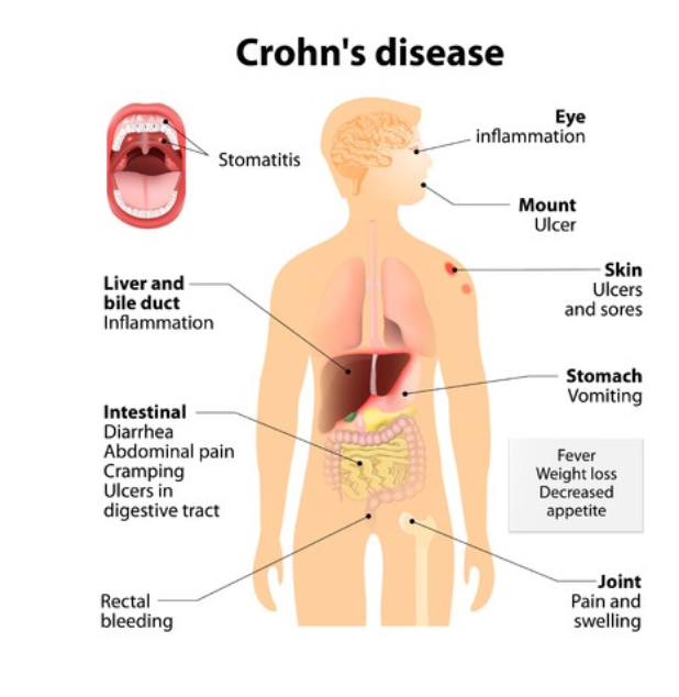 Cannabis Treatment for Crohn’s Disease