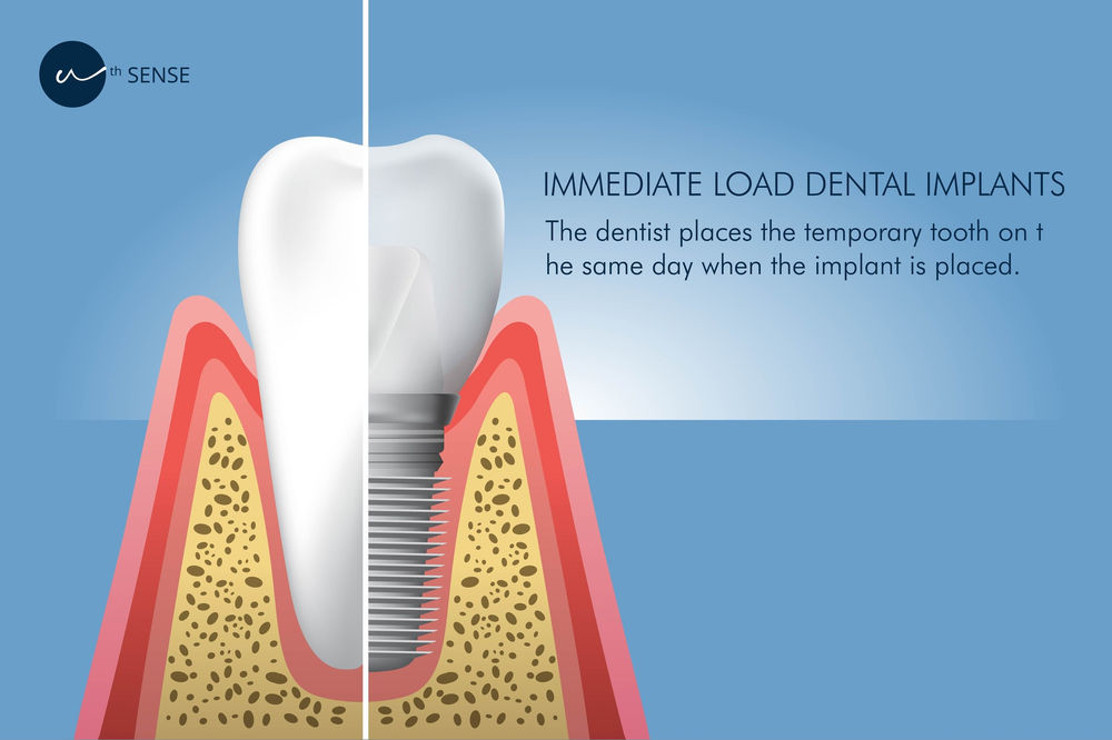 All about Dental Implants Dr. Purav Mehta Dental Care