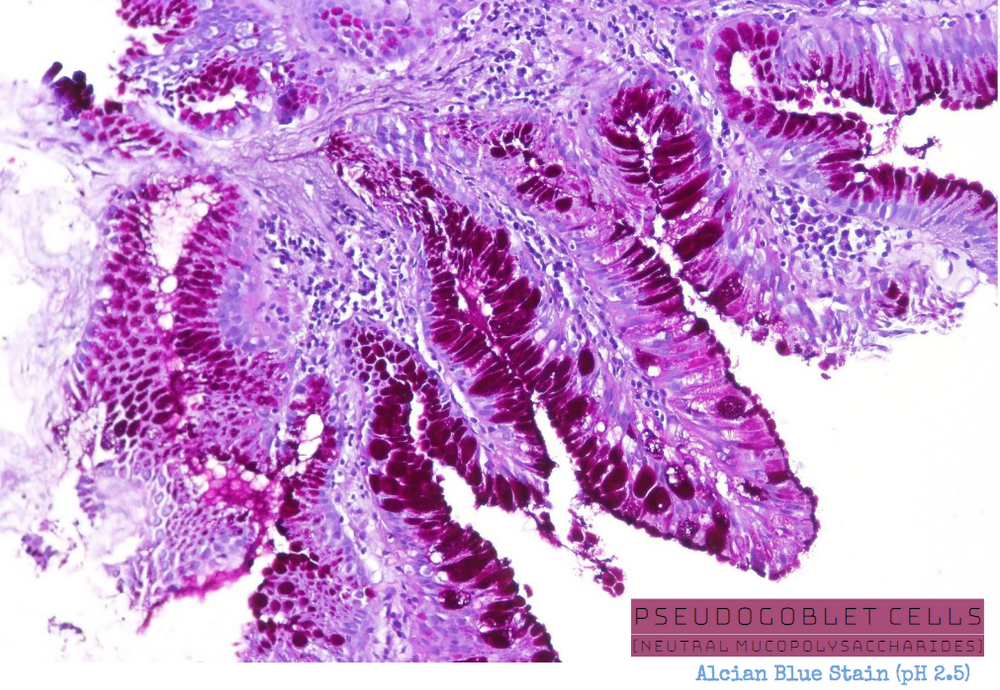 High Yield GI Pathology Esophagus GERD & Barrett Metaplasia