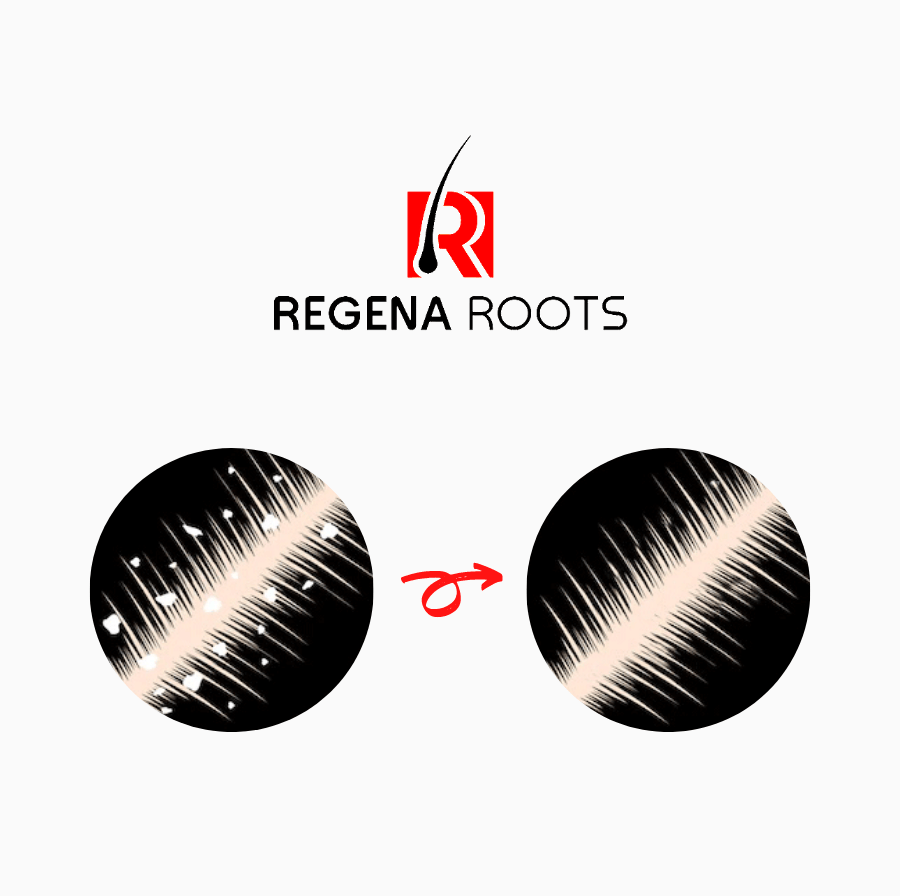 Hair fall treatment - natural ingredients for healthy hair | Regena Roots content media
