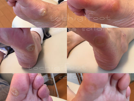ご高齢の方のフットケア