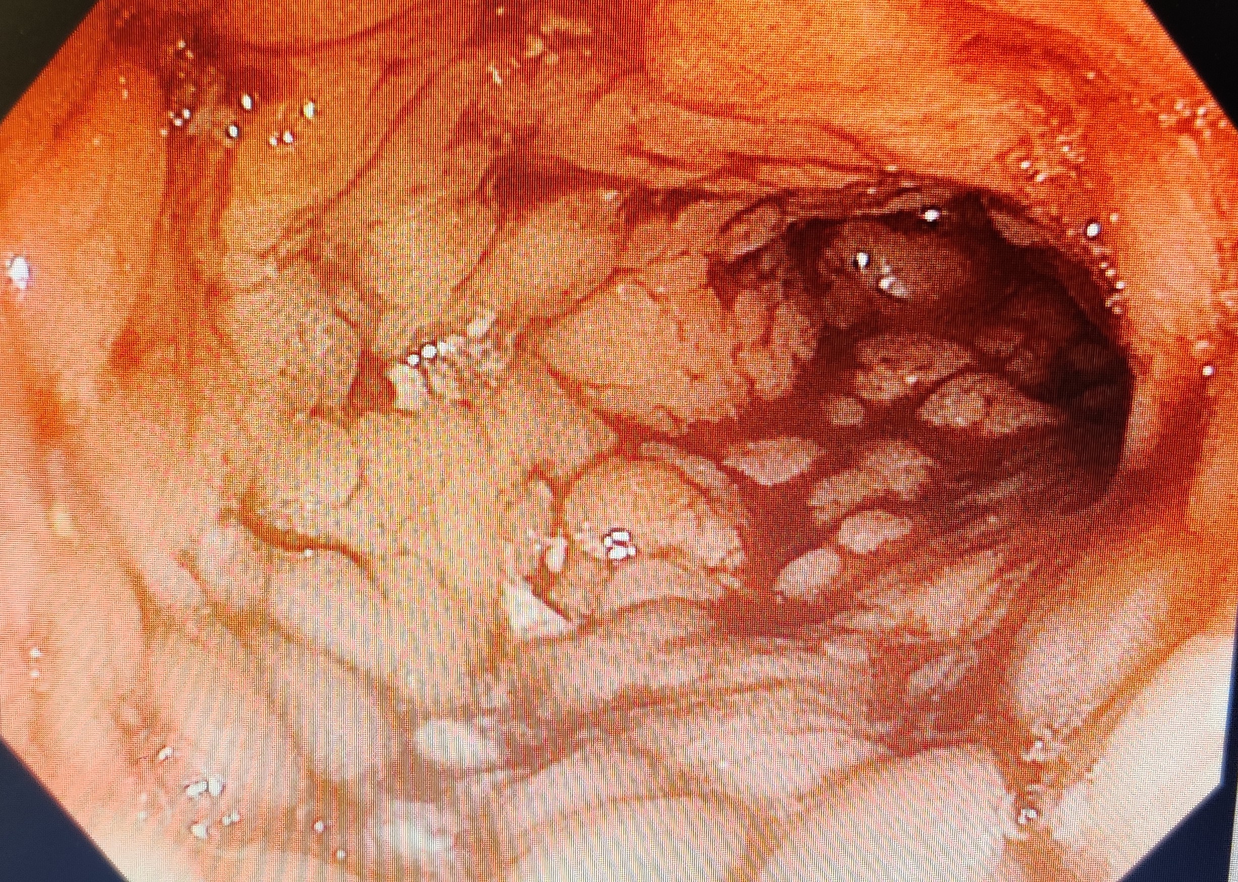Crohns vs TB content media