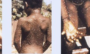 10 facts you need to know about the monkeypox virus