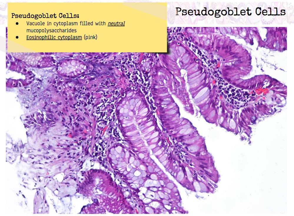 High Yield GI Pathology Esophagus GERD & Barrett Metaplasia