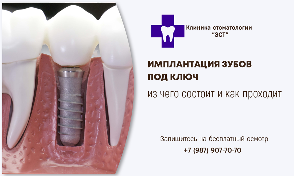 имплантация зубов под ключ