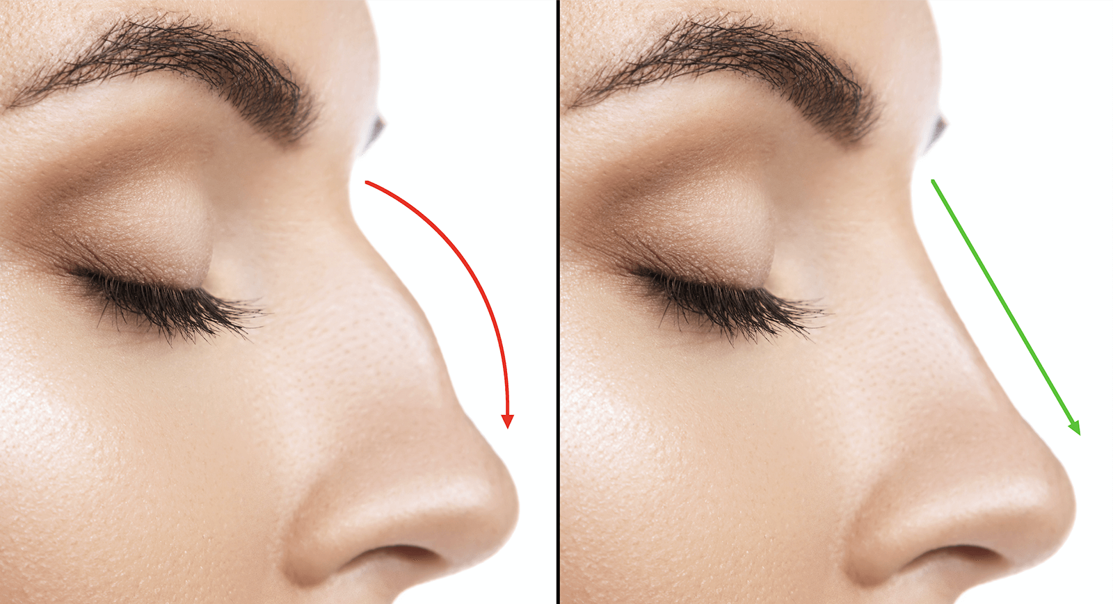 Best rhinoplasty surgeon in Delhi content media