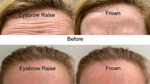 What Are Botox Injections?