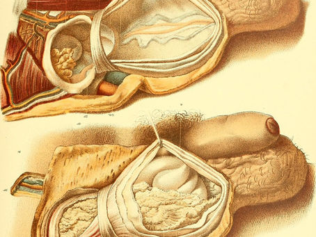 Hernia inguinal: ¿Qué es?