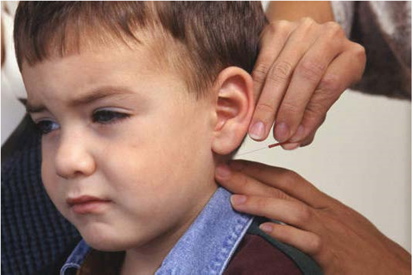 Acupunctuur bij kinderen