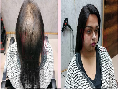 Best Hair Wigs Services in Delhi @https://www.lynxhairskin.com/hair-wigs-delhi/ content media