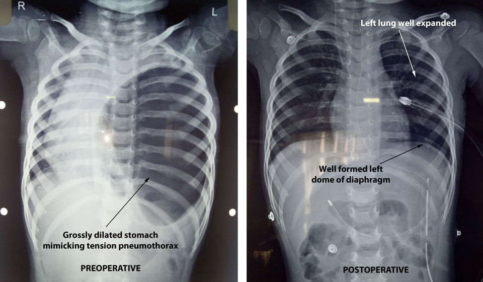 Congenital Diaphragmatic Hernia Masquerading as Tension Pneumothorax